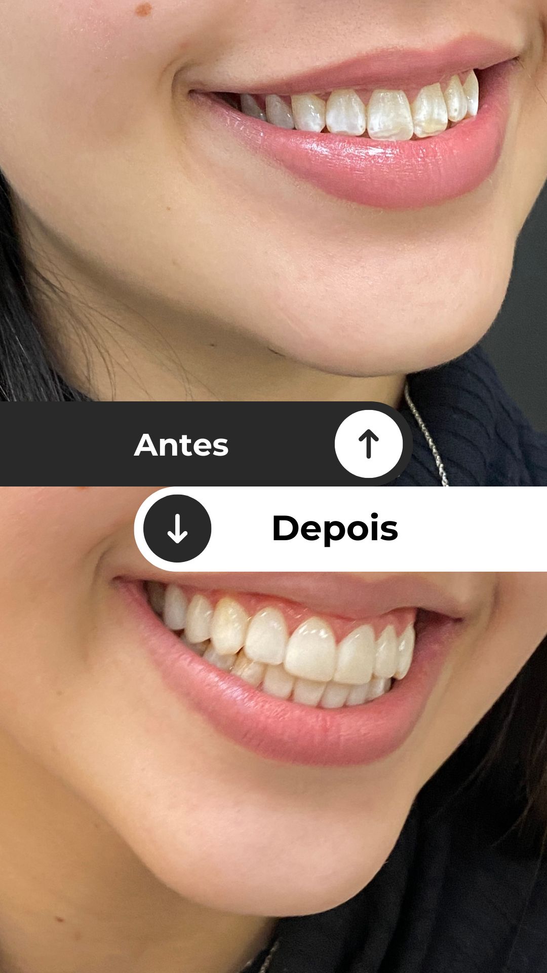 Antes e Depois — Lentes de Porcelana Dr. Saint Clair